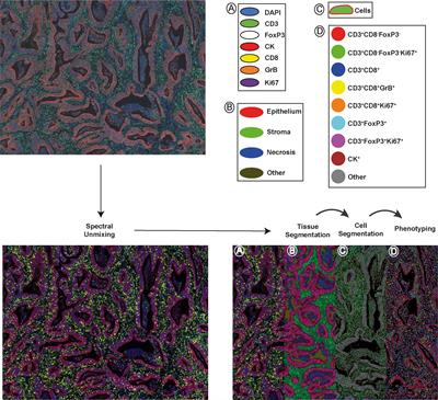 Location matters: spatial dynamics of tumor-infiltrating T cell subsets is prognostic in colon cancer